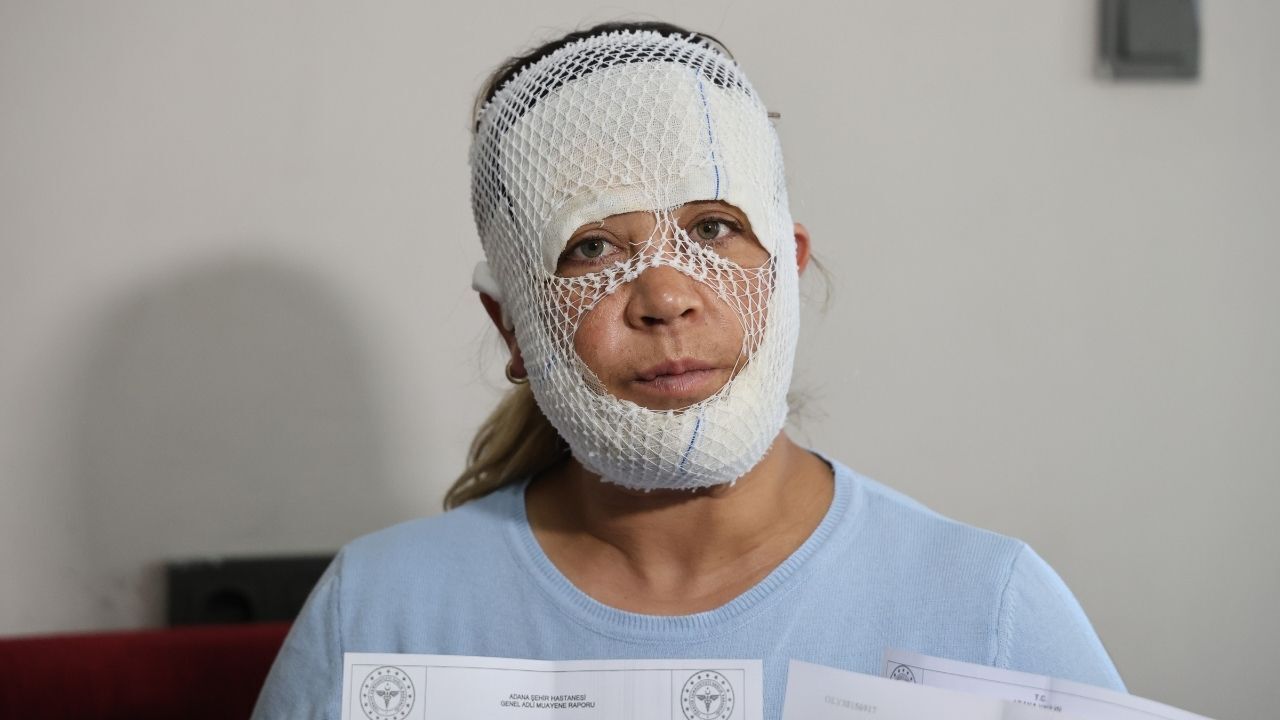 Adana’da Cilt Bakımı Faciaya Dönüştü Yüzünde 2. Derece Yanık Oluştu