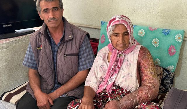 Kolu şişti, vücuduna kadar yara oldu: 4 çocuk annesinin zorlu yaşamı